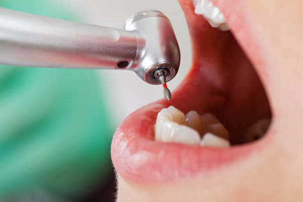 Best Emergency Tooth Extraction in Killian, LA